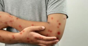 10 STD'S that are WORSE than HIV/AIDS